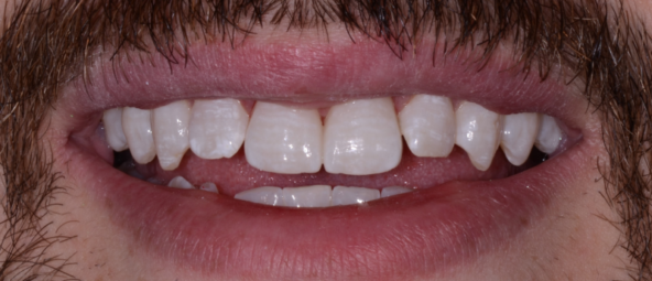 after zoom teeth whitening at RiverWalk Family Dental