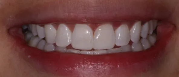 after Before treatment at RiverWalk Family Dental