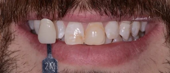 before zoom teeth whitening at RiverWalk Family Dental