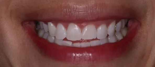 Before treatment at RiverWalk Family Dental