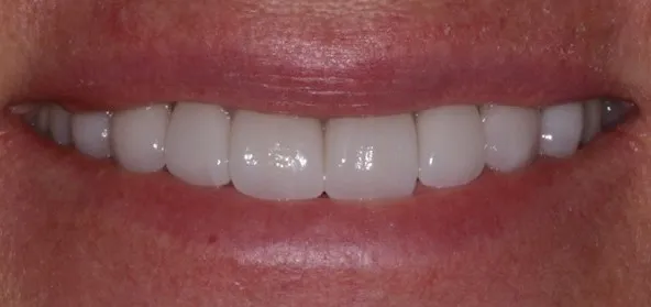 after treatment at RiverWalk Family Dental