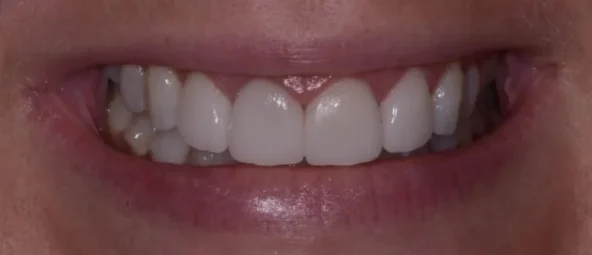 after treatment at RiverWalk Family Dental