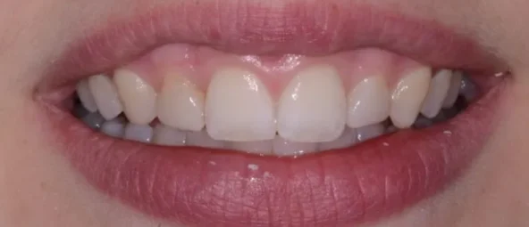 Before treatment at RiverWalk Family Dental