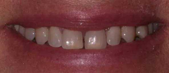 Before treatment at RiverWalk Family Dental