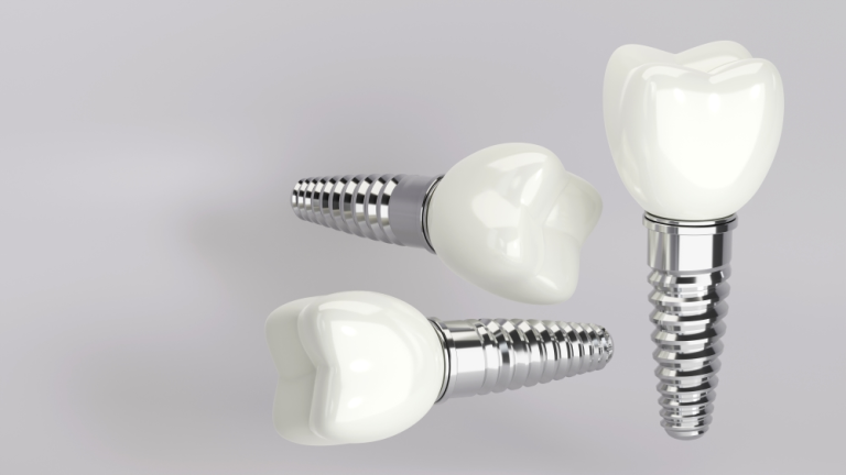 dental implants in Naperville