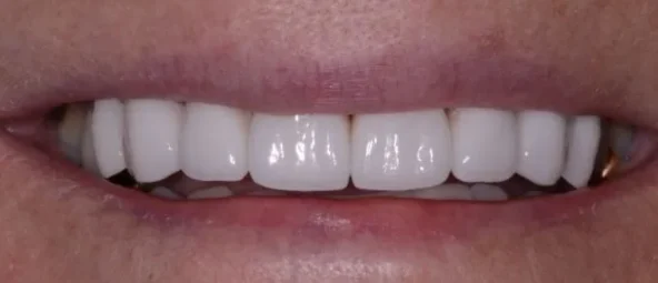 after treatment at RiverWalk Family Dental