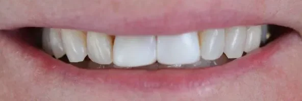 Before treatment at RiverWalk Family Dental