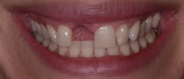 Before treatment at RiverWalk Family Dental