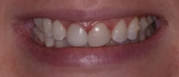 Before treatment at RiverWalk Family Dental