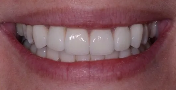 after treatment at RiverWalk Family Dental