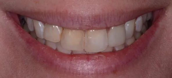Before treatment at RiverWalk Family Dental