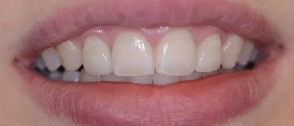 after treatment at RiverWalk Family Dental