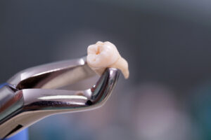 extracted tooth