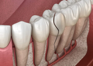 Cracked,Tooth,,Splitted