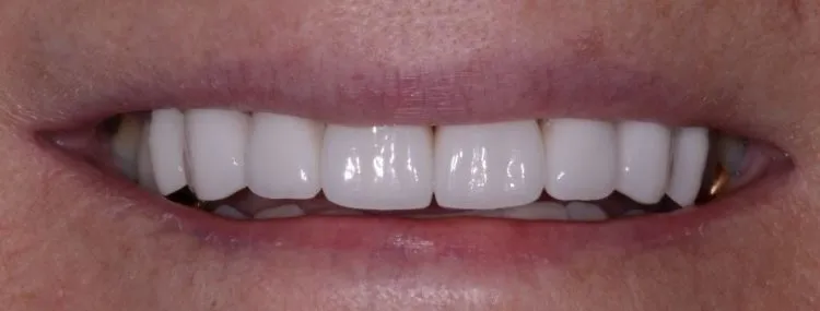 Smile Gallery full front view smile after