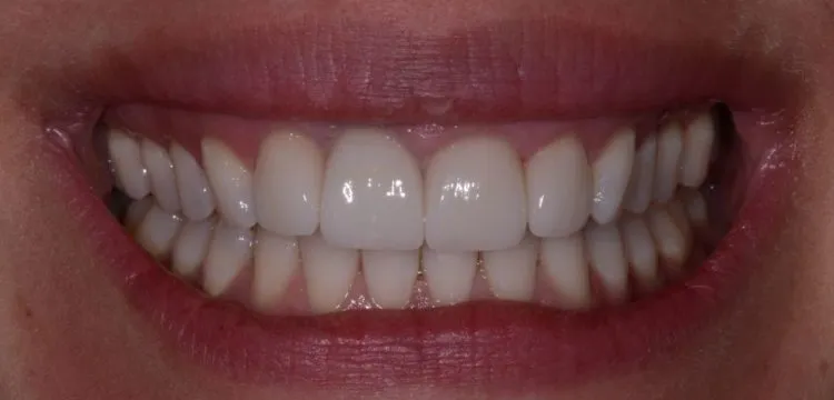 Smile Gallery full front view smile after