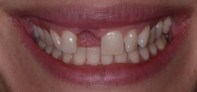 Smile Gallery full front with missing front tooth before