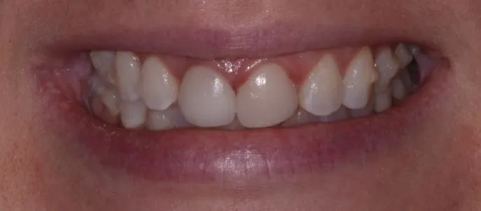 Smile Gallery full front view smile before