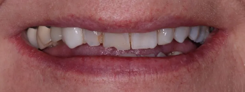 Smile Gallery full front view smile before