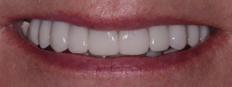 Smile Gallery full front view smile after