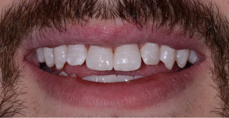 Smile Gallery full front view smile of a man with a mustache after