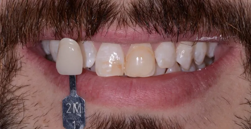 Smile Gallery full front view smile of a man with a mustache and tooth extended before