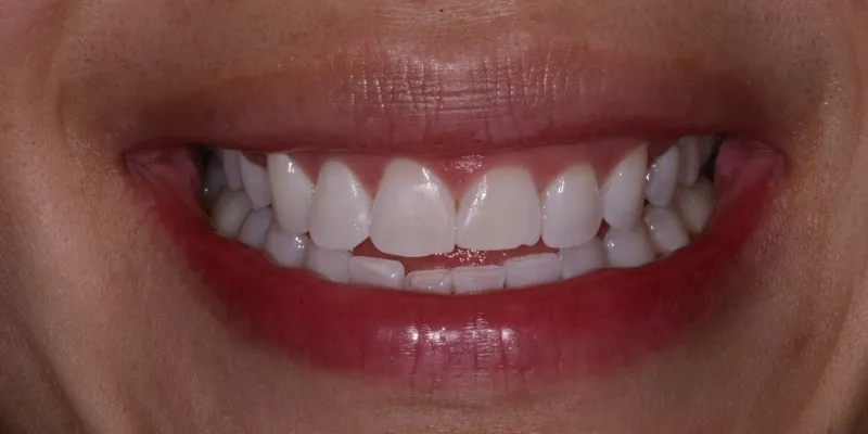 Smile Gallery full front view smile before